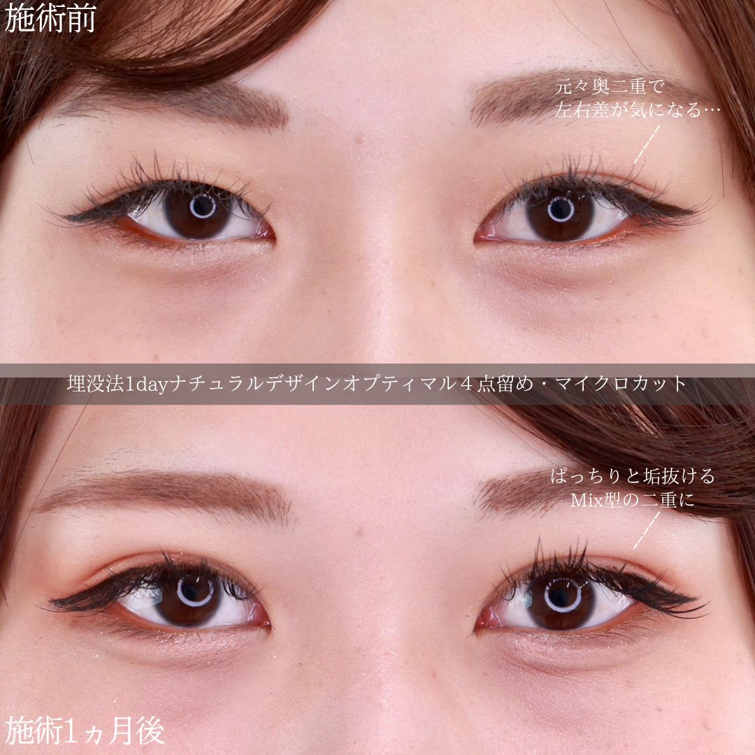 二重埋没法/目元：その他の症例写真 施術前後 