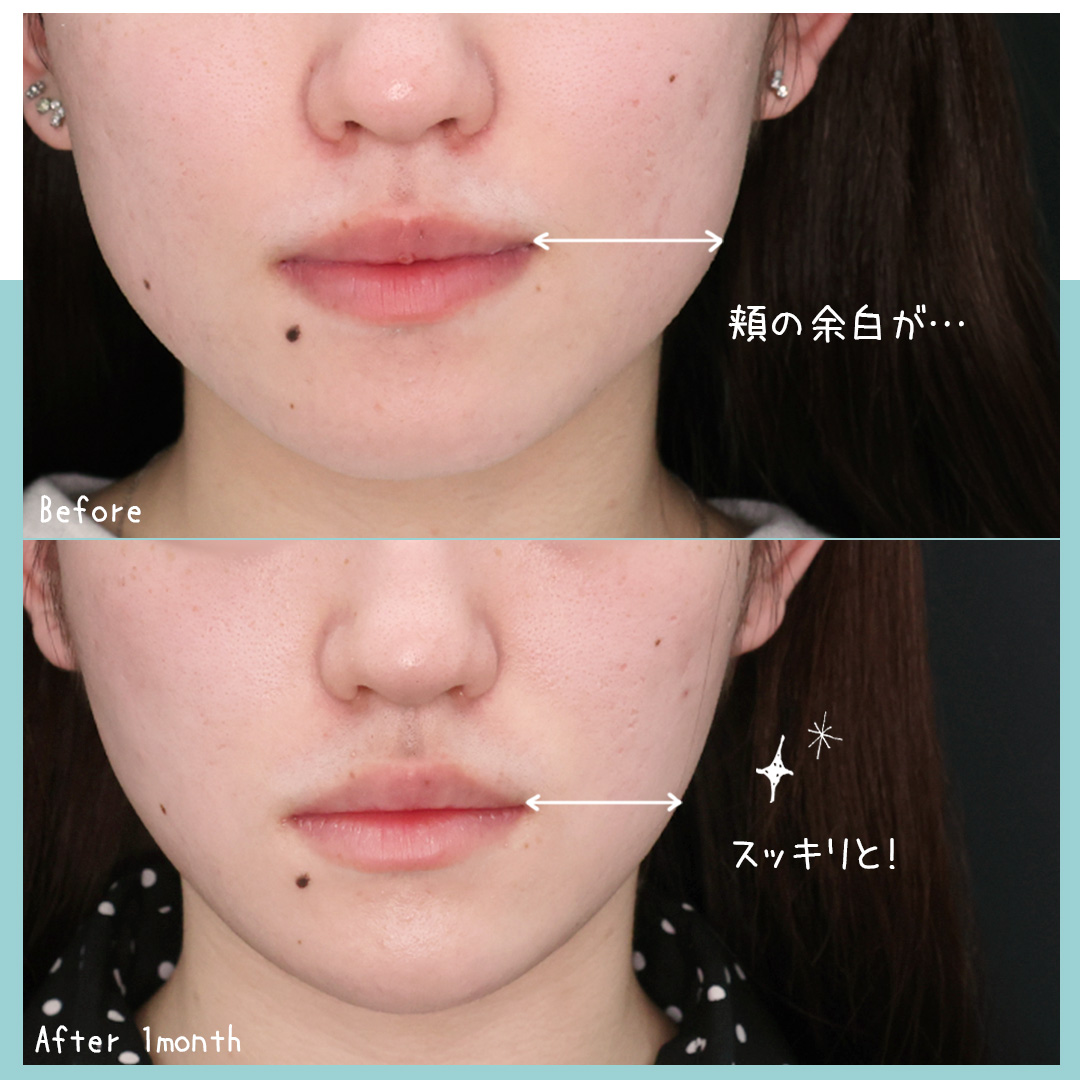 TAC式 ツヤ肌コラーゲンリフト®/Lラインファット除去（エラ下脂肪除去）/顎のヒアルロン酸注射の症例写真 施術前後 