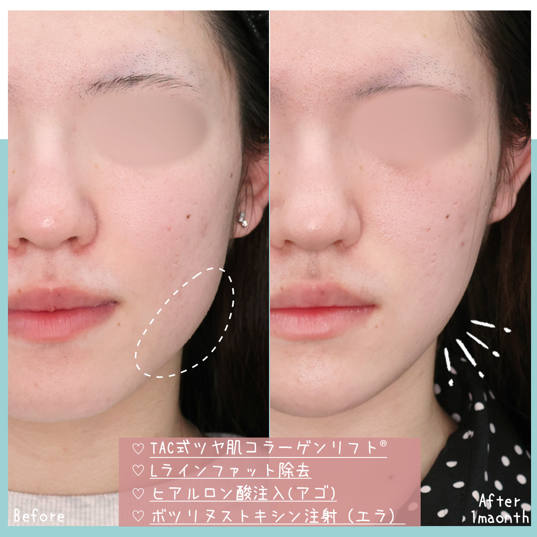 TAC式 ツヤ肌コラーゲンリフト®/Lラインファット除去（エラ下脂肪除去）/顎のヒアルロン酸注射の症例写真 施術前後 