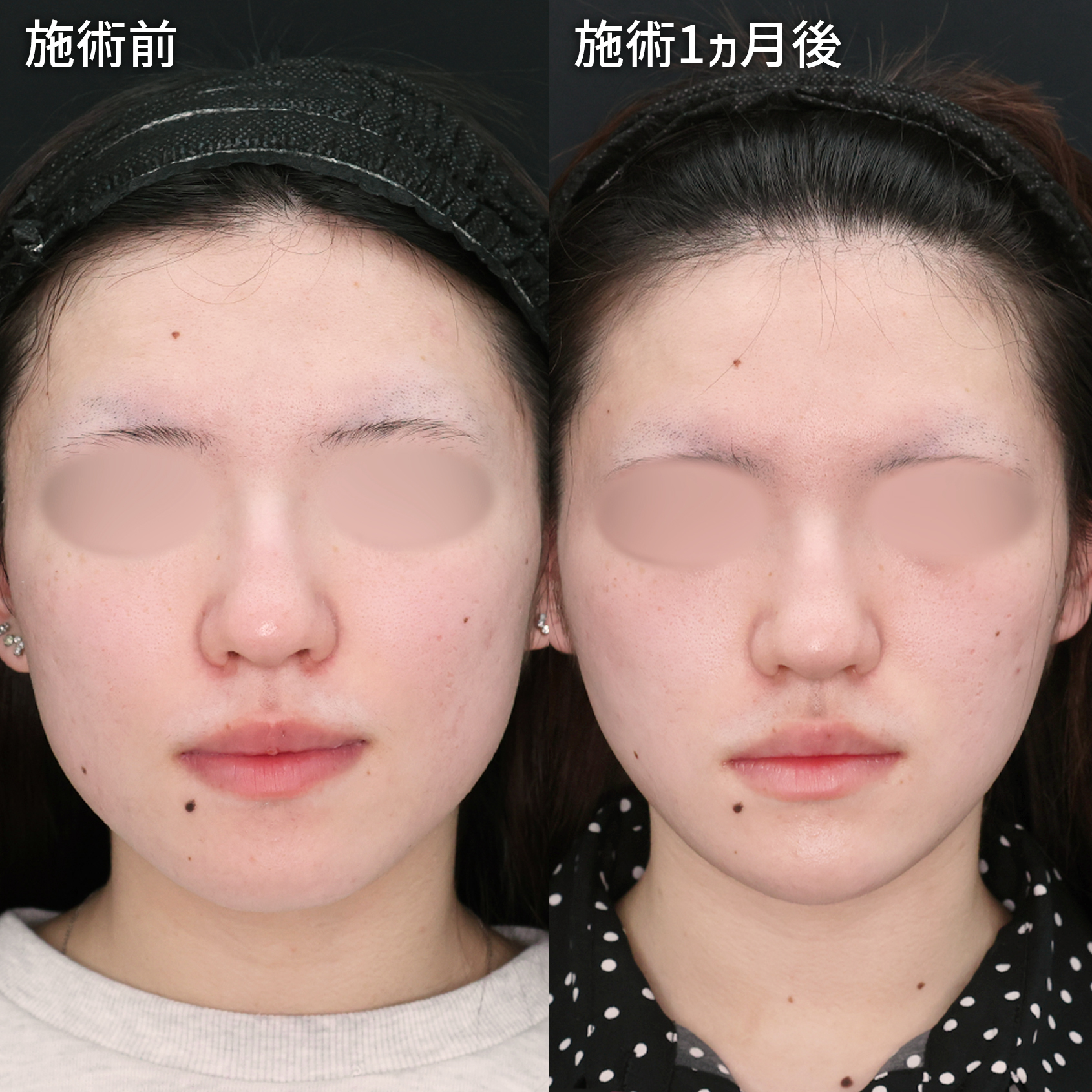 【パーフェクトフェイスライン】憧れの卵型輪郭に！