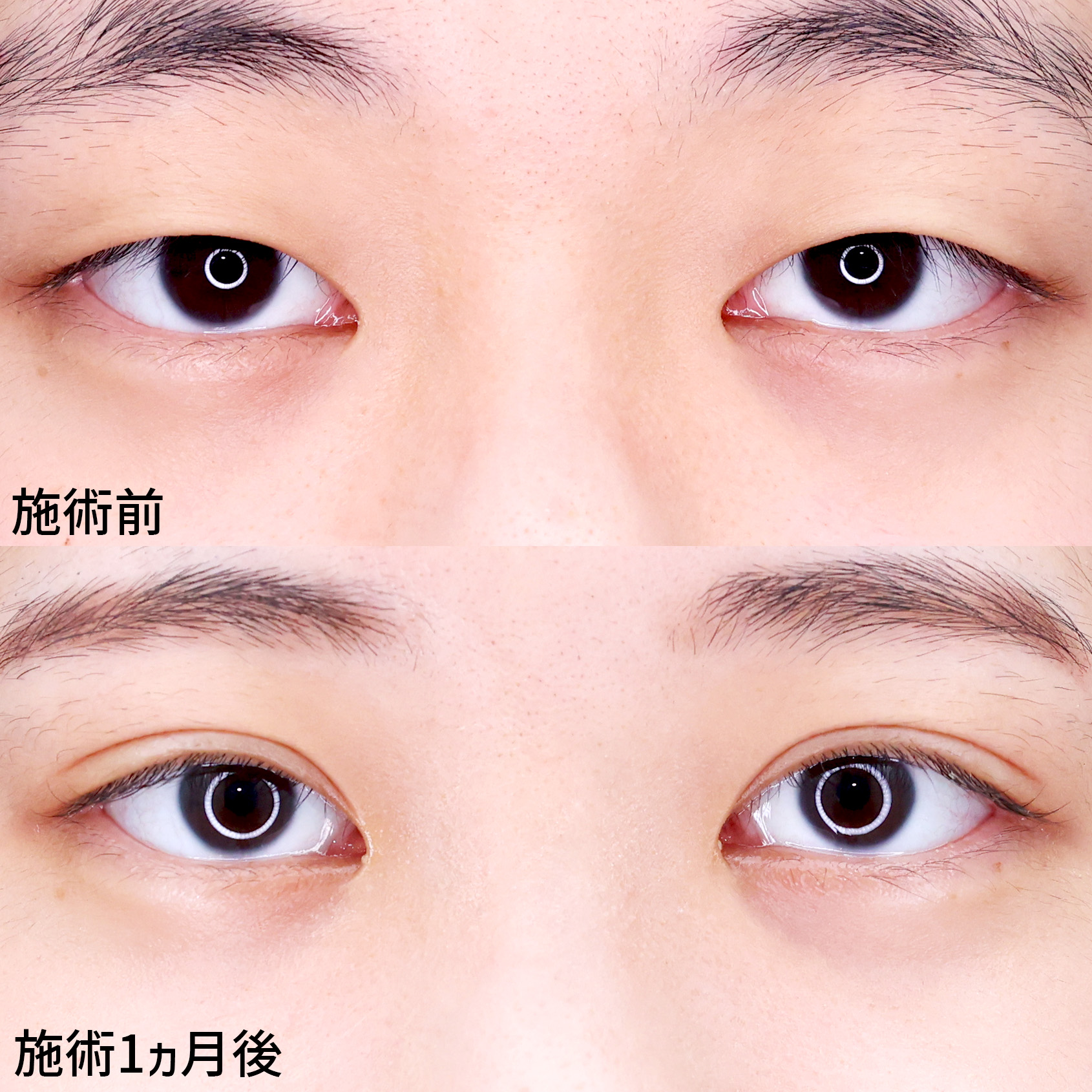 目力アップ！【二重埋没法】で華やかな目元に