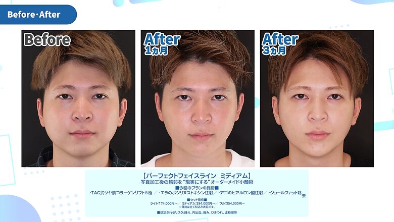 術前・術後1ヵ月・術後3ヵ月の正面の比較写真
