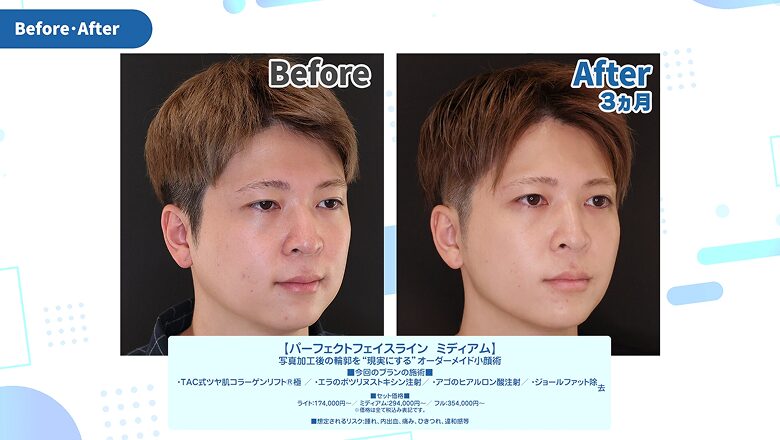 術前と術後3ヵ月の斜めからのビフォーアフター比較写真