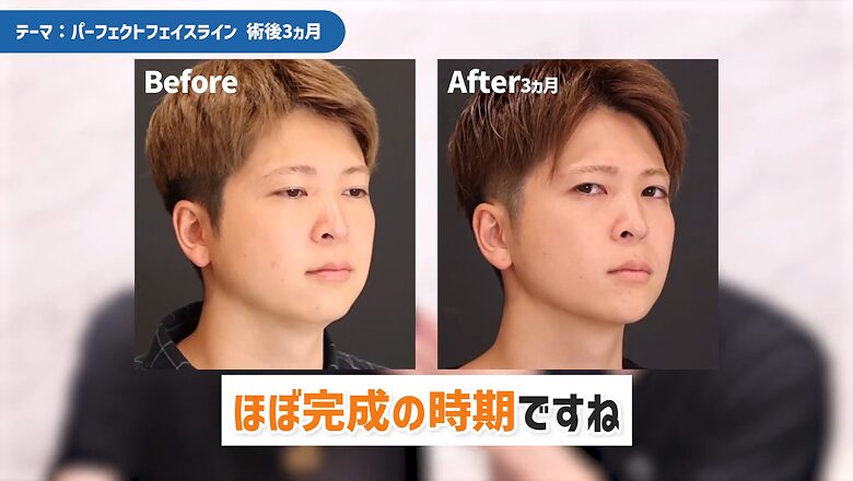術後3ヵ月の斜めからのビフォーアフター
