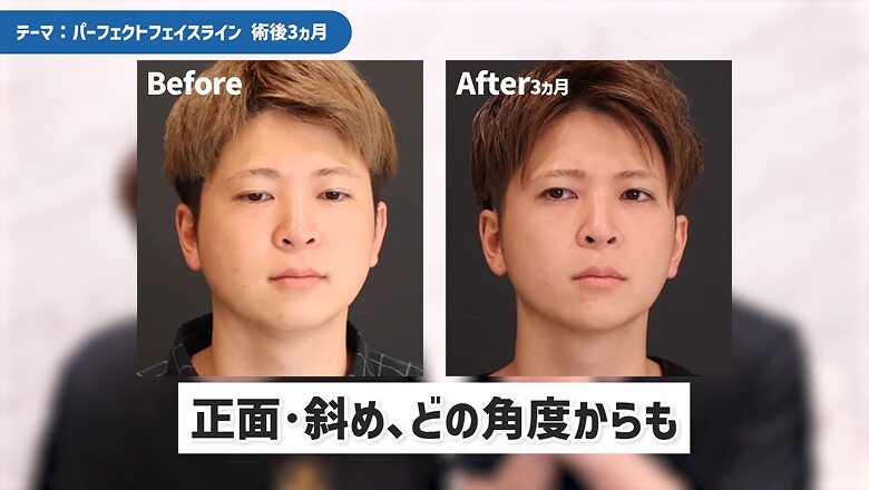 術後3ヵ月の正面からのビフォーアフター