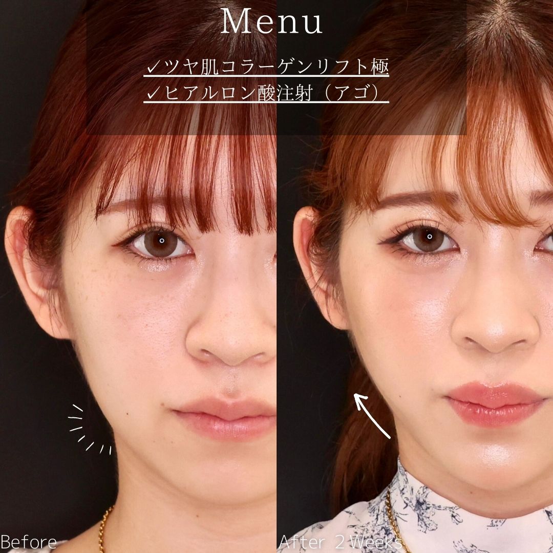TAC式 ツヤ肌コラーゲンリフト®/顎のヒアルロン酸注射の症例写真 施術前後 