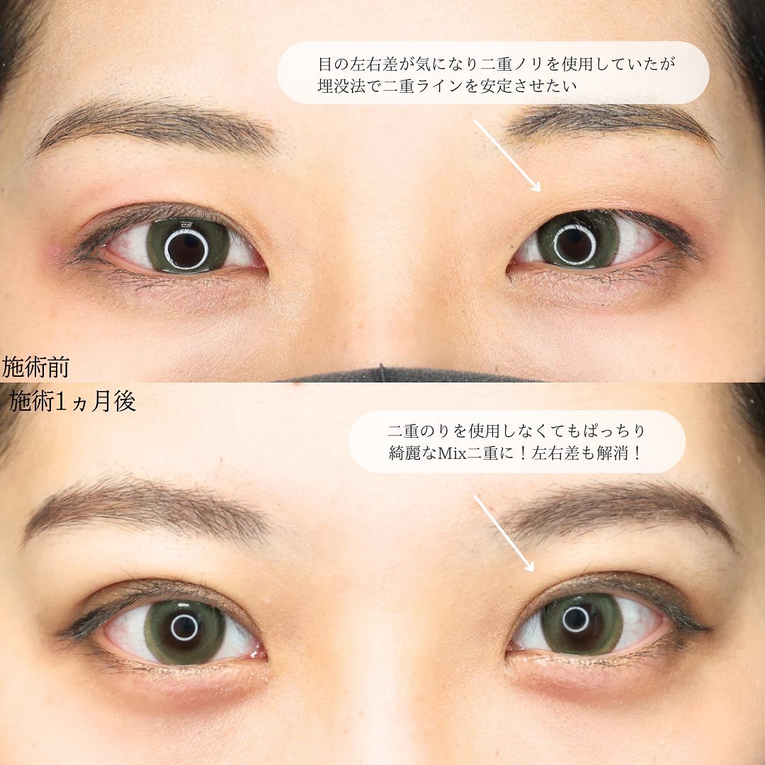 二重埋没法の症例写真 施術前後 