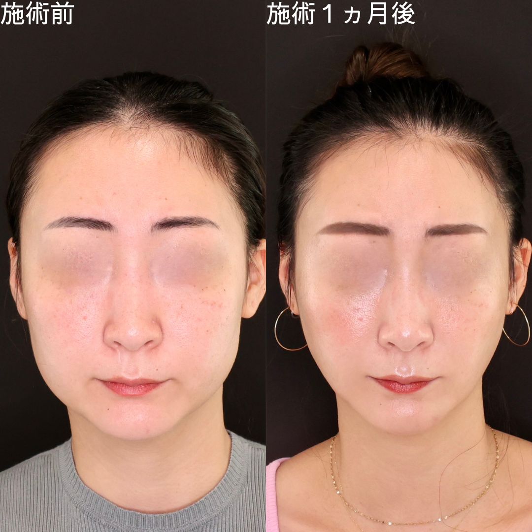 下膨れ顔とは言わせないDr.石橋のモデル級小顔術【糸リフト×脂肪除去】