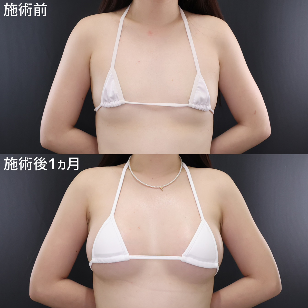 シリコンバッグ豊胸(人工乳腺バッグ)の症例写真 施術前後