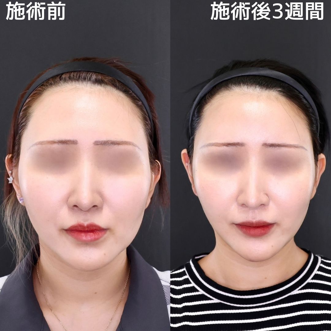 【糸リフト×脂肪除去・吸引】もたつきのないシャープなフェイスラインへ