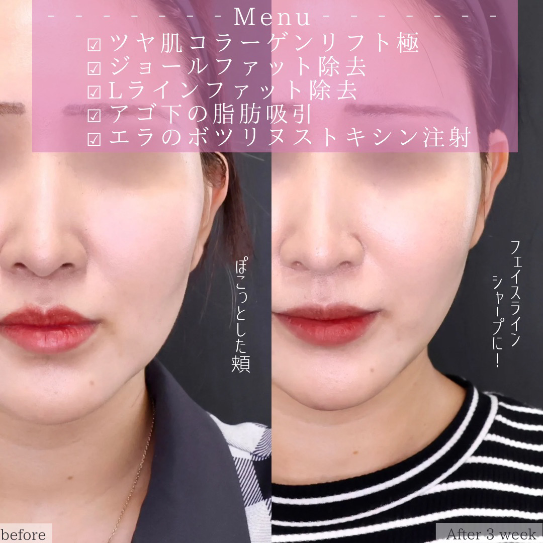 TAC式 ツヤ肌コラーゲンリフト®/ジョールファット除去/Lラインファット除去（エラ下脂肪除去）の症例写真 施術前後 