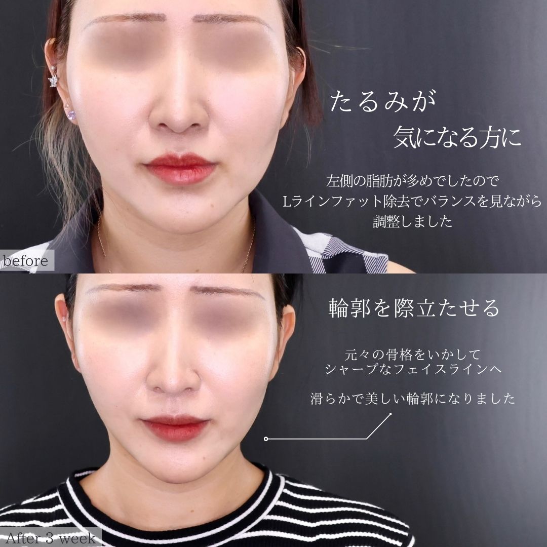 TAC式 ツヤ肌コラーゲンリフト®/ジョールファット除去/Lラインファット除去（エラ下脂肪除去）の症例写真 施術前後 