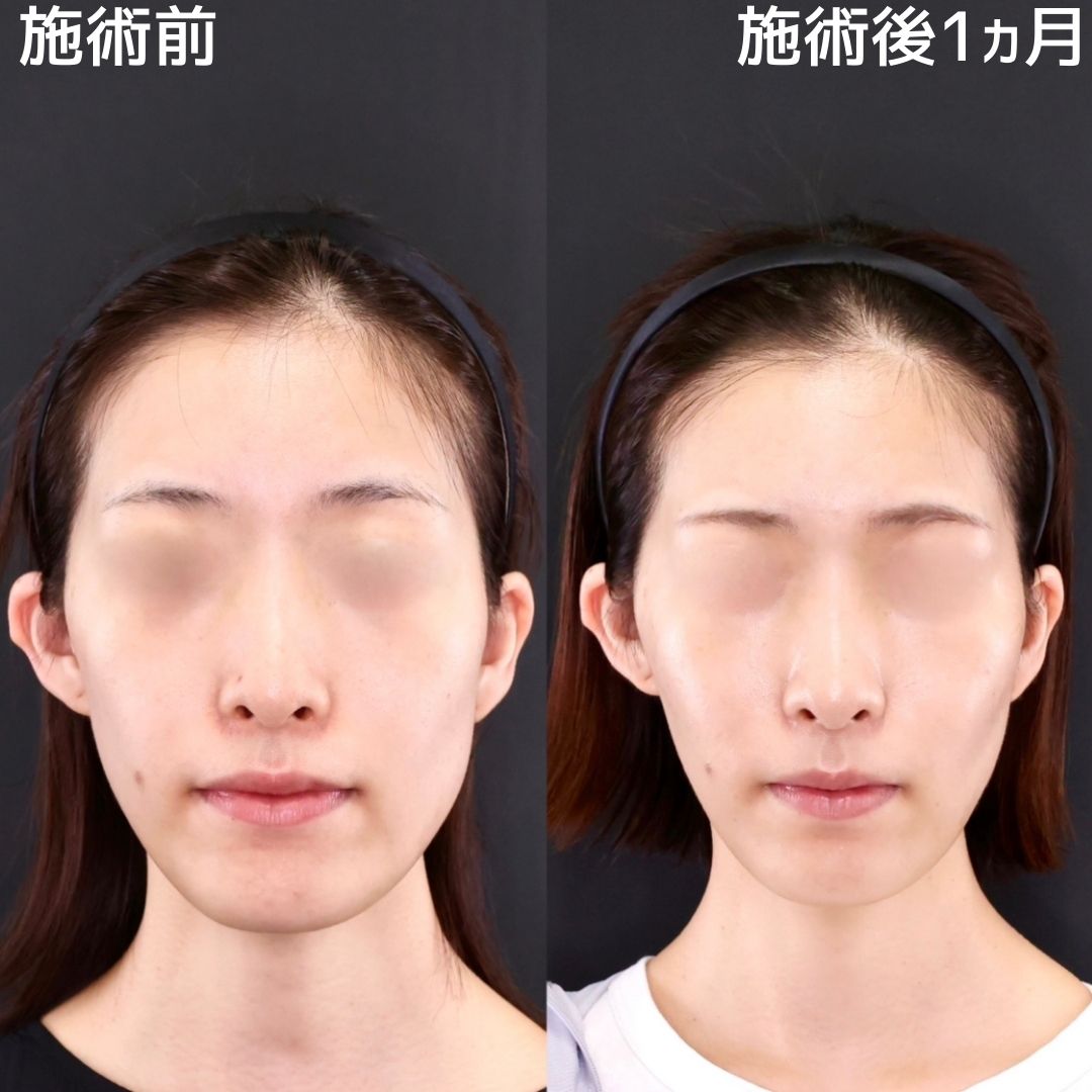 【糸リフト×脂肪除去・吸引】小顔で左右差改善!