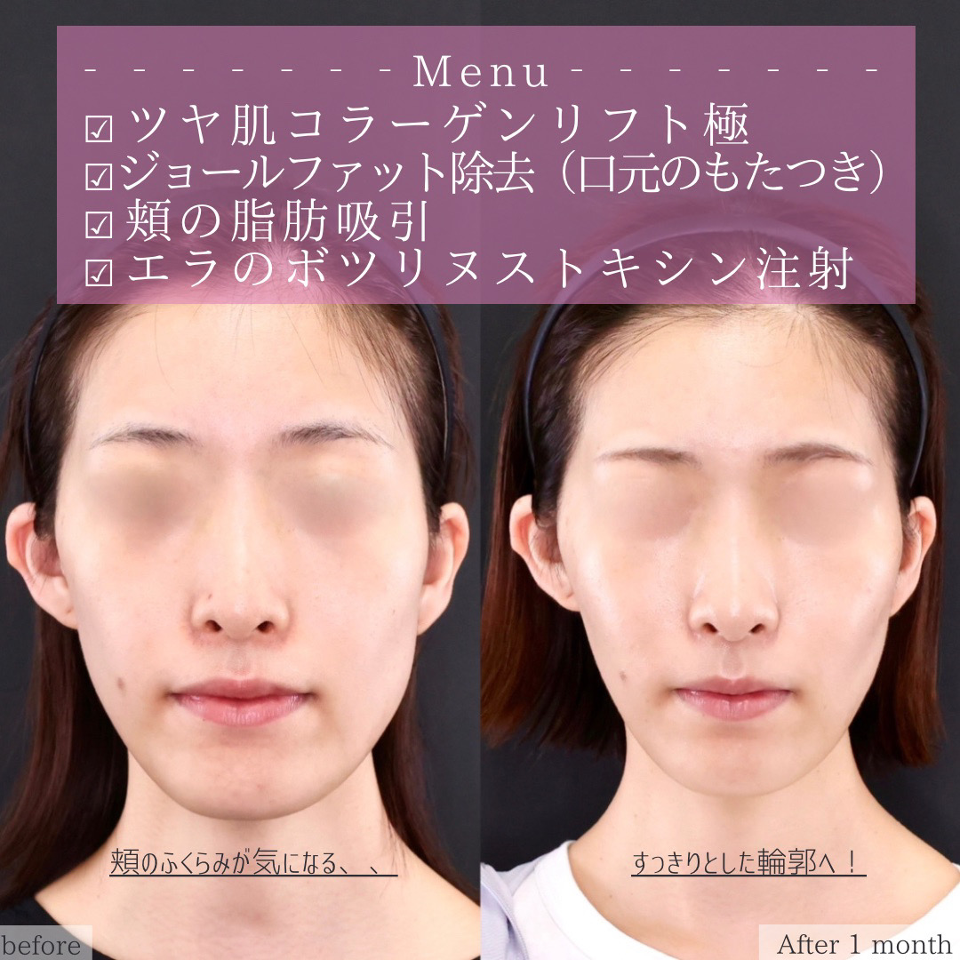 TAC式 ツヤ肌コラーゲンリフト®/ジョールファット除去/エラボトックス注射の症例写真 施術前後 