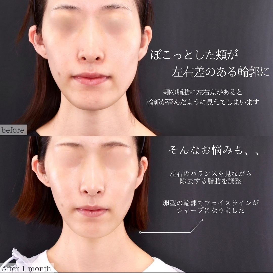 TAC式 ツヤ肌コラーゲンリフト®/ジョールファット除去/エラボトックス注射の症例写真 施術前後 