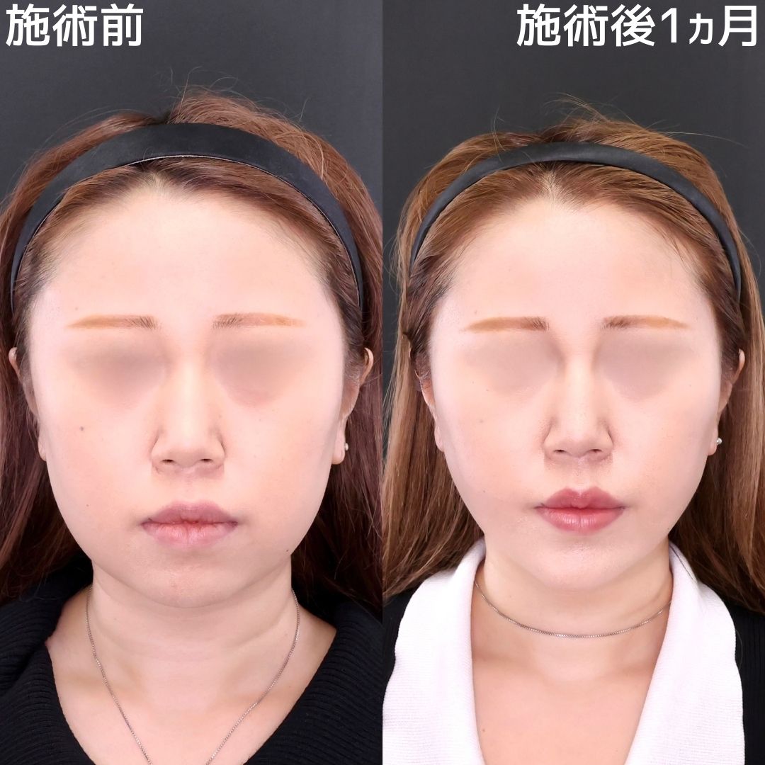 【糸リフト×脂肪除去】輪郭を整えて垢抜けた小顔に