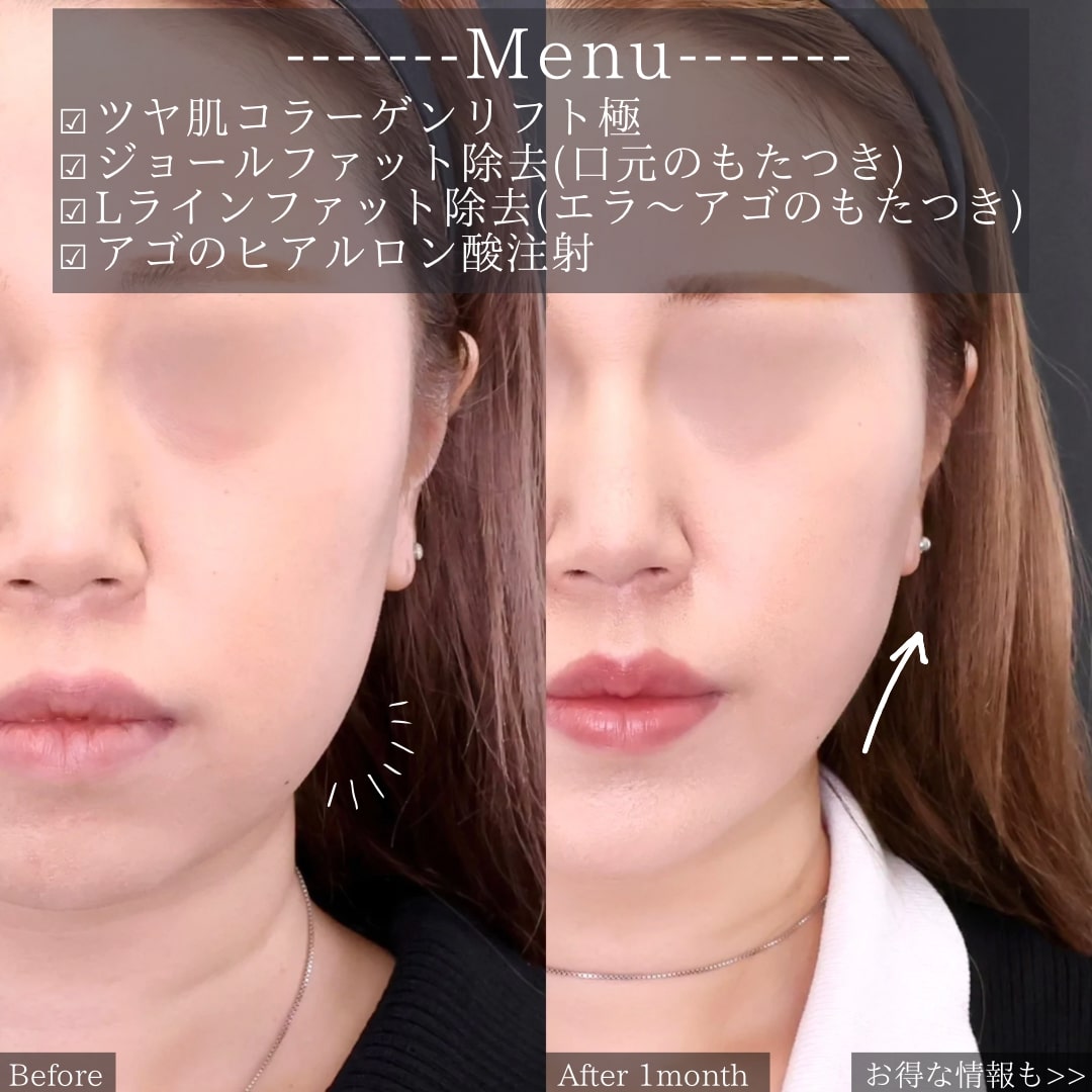 TAC式 ツヤ肌コラーゲンリフト®/ジョールファット除去/Lラインファット除去（エラ下脂肪除去）の症例写真 施術前後 