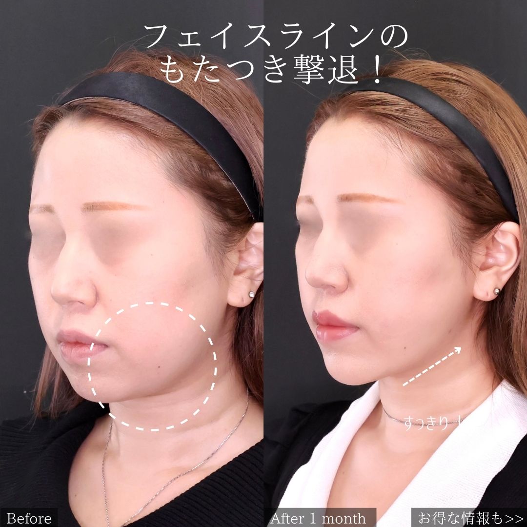 TAC式 ツヤ肌コラーゲンリフト®/ジョールファット除去/Lラインファット除去（エラ下脂肪除去）の症例写真 施術前後 
