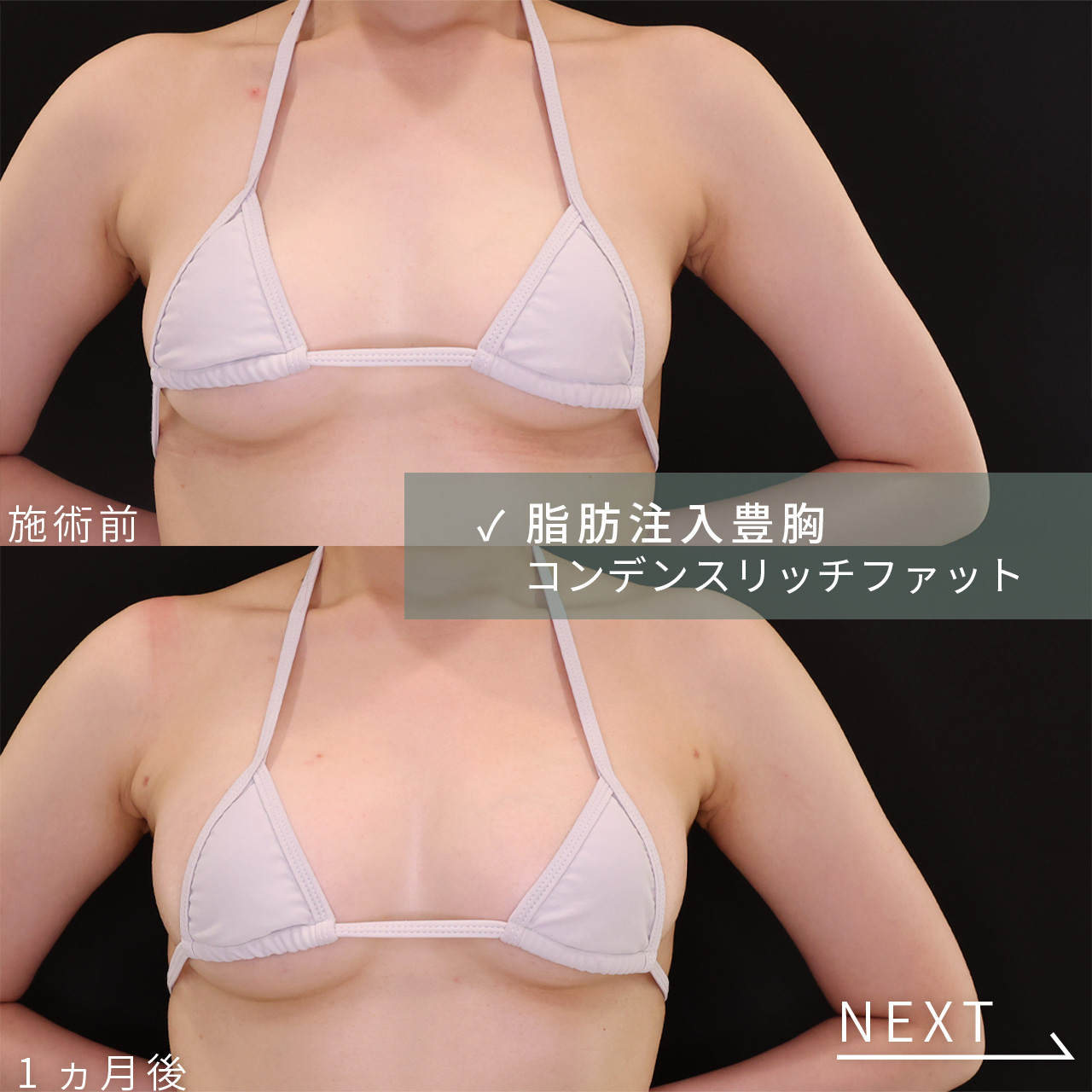 脂肪注入豊胸（コンデンスリッチ・ピュアグラフト・１day脂肪豊胸）の症例写真 施術前後 