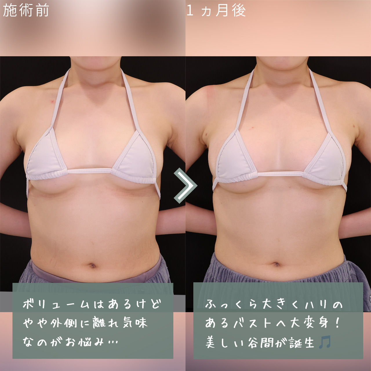 脂肪注入豊胸（コンデンスリッチ・ピュアグラフト・１day脂肪豊胸）の症例写真 施術前後 