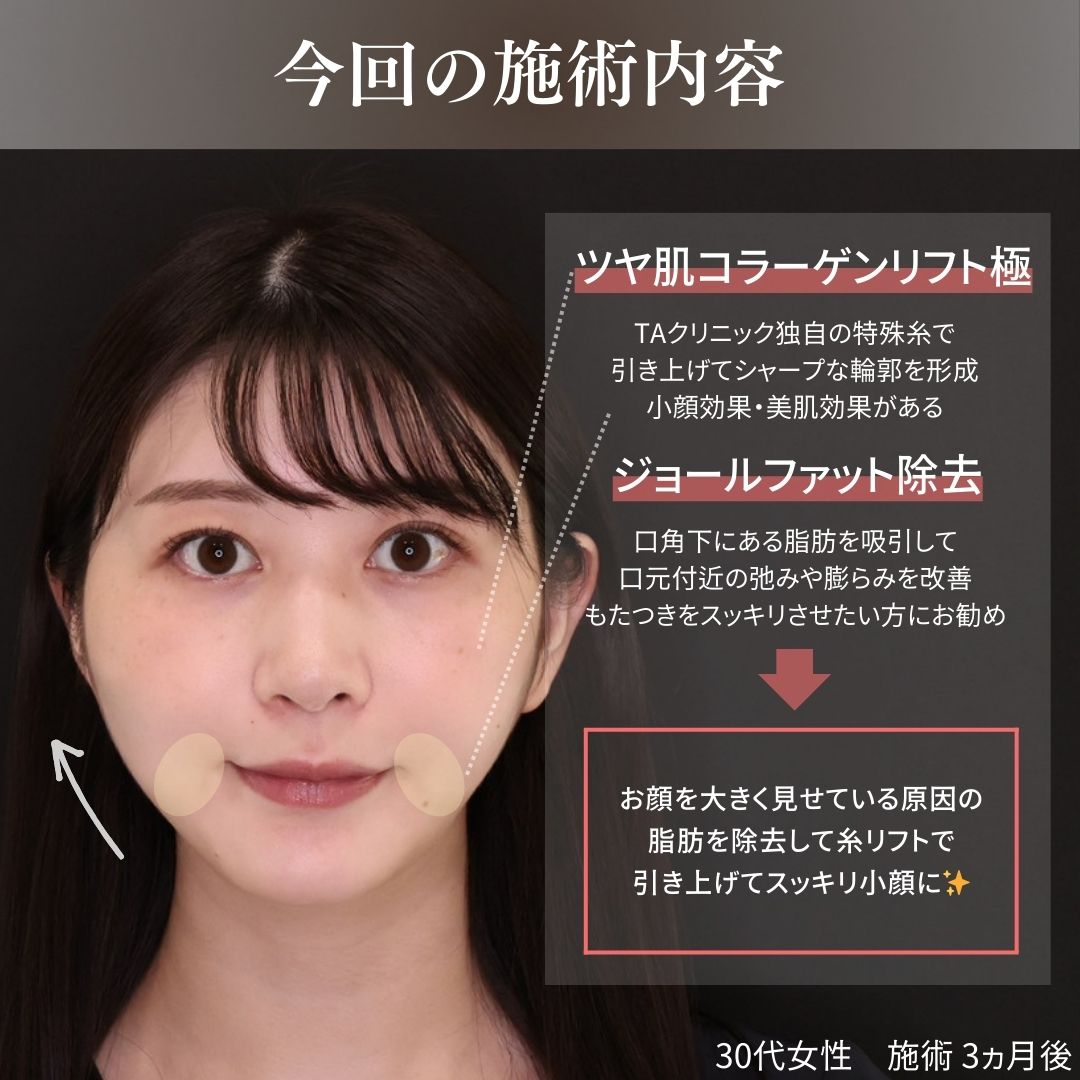 TAC式 ツヤ肌コラーゲンリフト®の症例写真 施術前後 