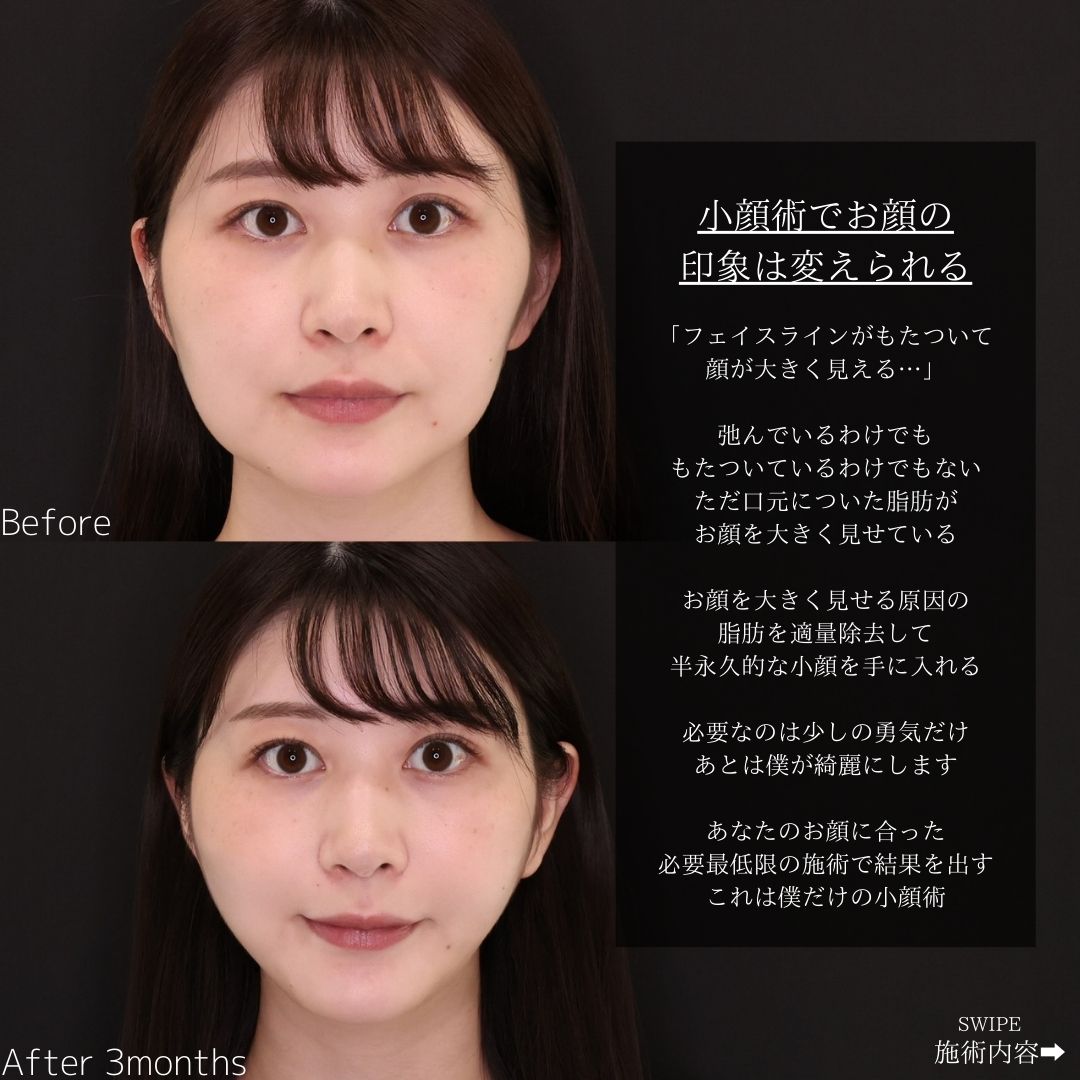 TAC式 ツヤ肌コラーゲンリフト®の症例写真 施術前後 