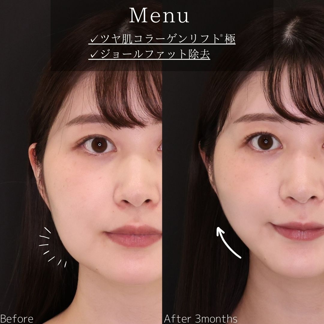 TAC式 ツヤ肌コラーゲンリフト®の症例写真 施術前後 