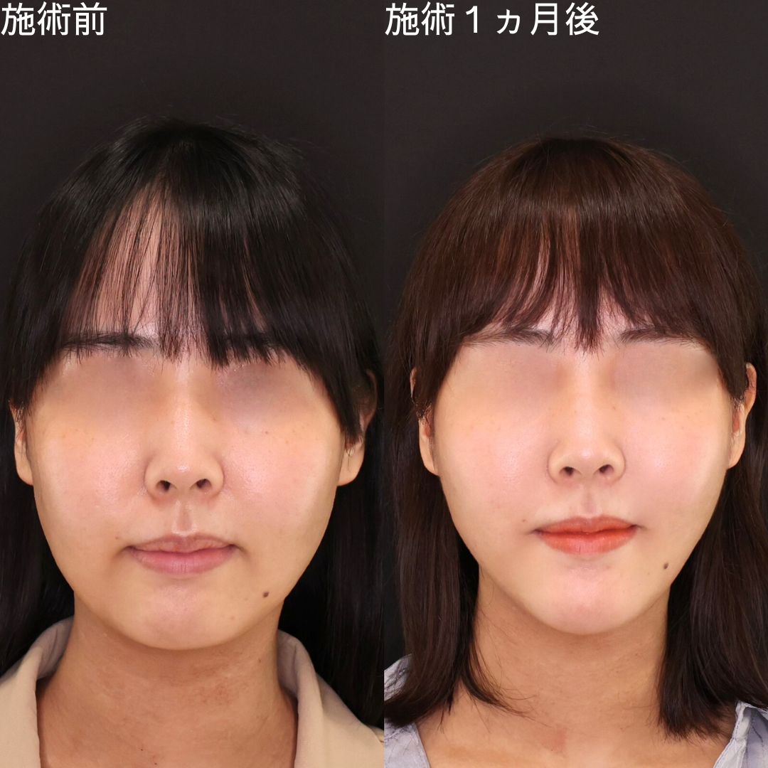 TAC式 ツヤ肌コラーゲンリフト®/ジョールファット除去/顎のヒアルロン酸注射の症例写真 施術前後