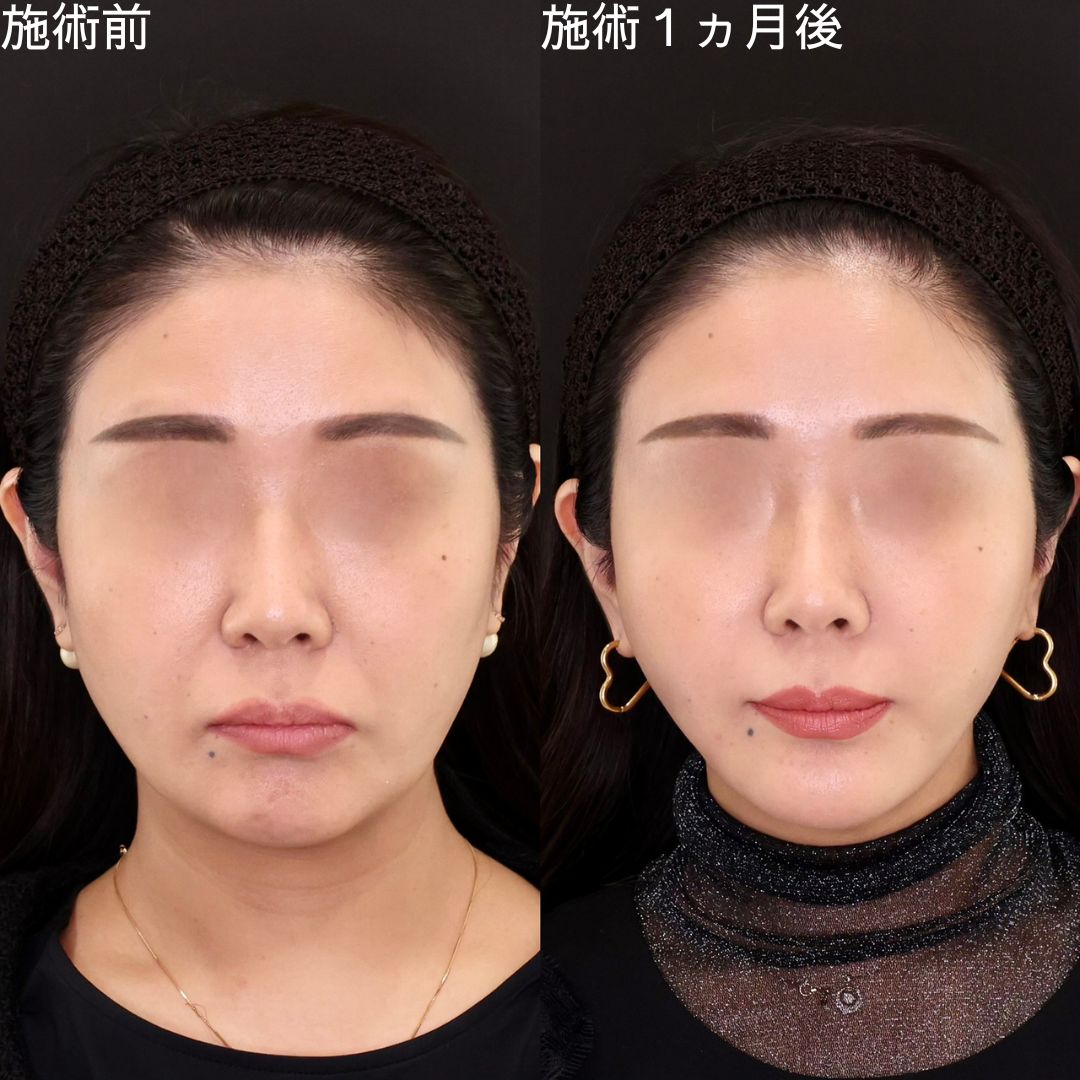 【糸リフト】でたるみ・もたつき０の輪郭に！