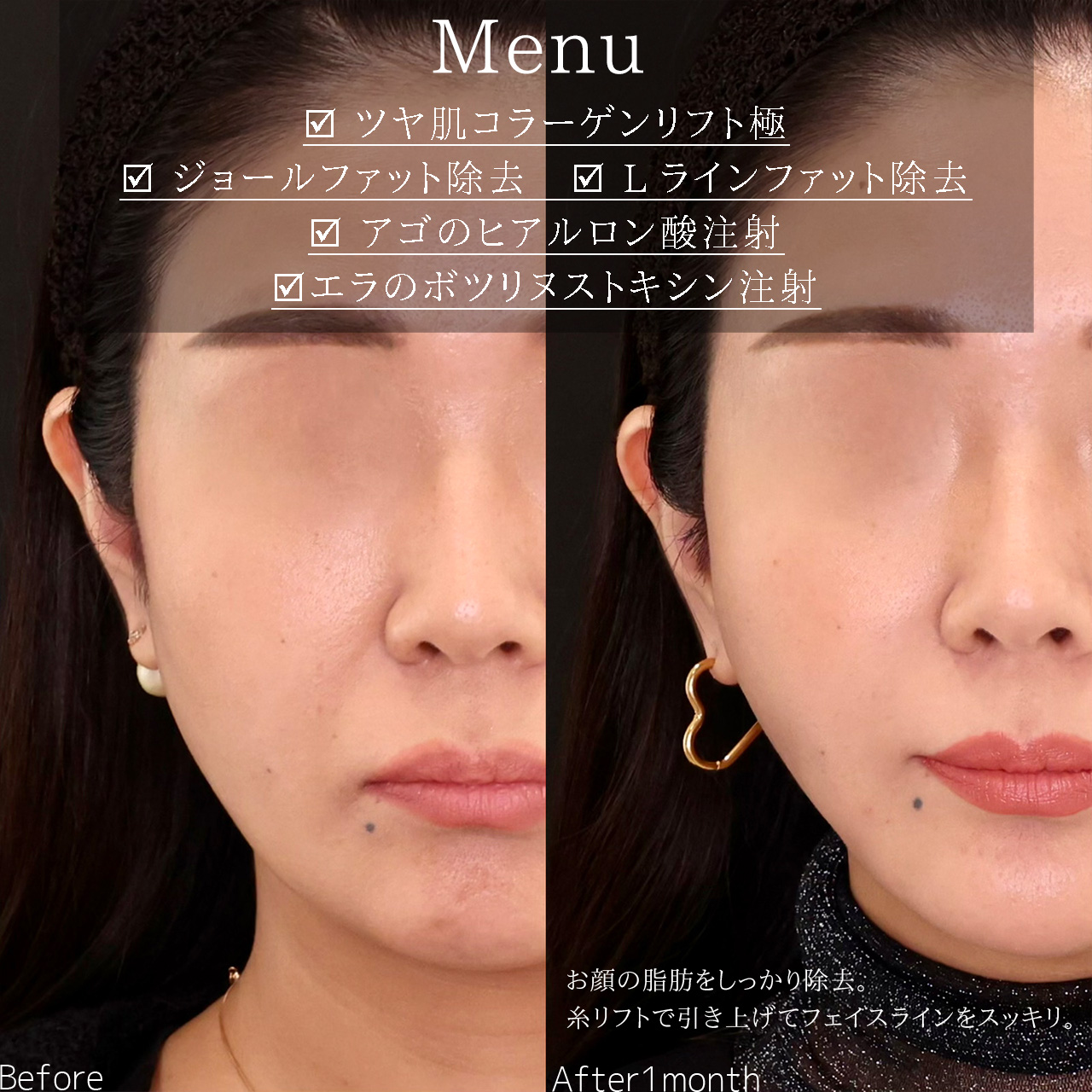 TAC式 ツヤ肌コラーゲンリフト®/ジョールファット除去/Lラインファット除去（エラ下脂肪除去）の症例写真 施術前後 