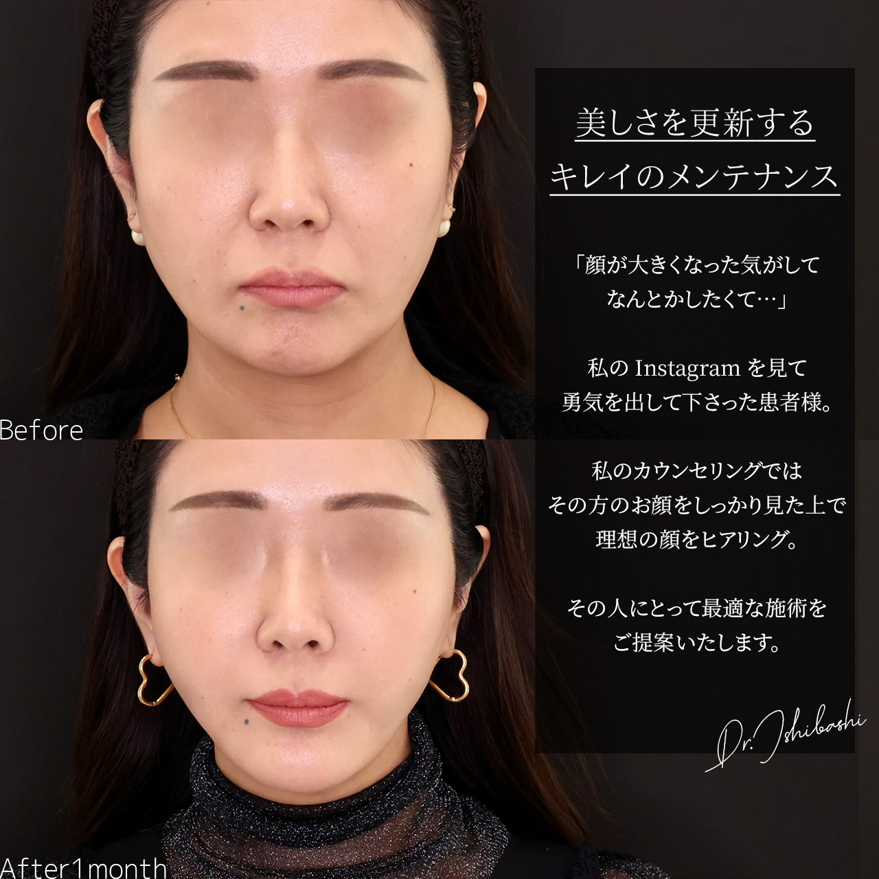 TAC式 ツヤ肌コラーゲンリフト®/ジョールファット除去/Lラインファット除去（エラ下脂肪除去）の症例写真 施術前後 