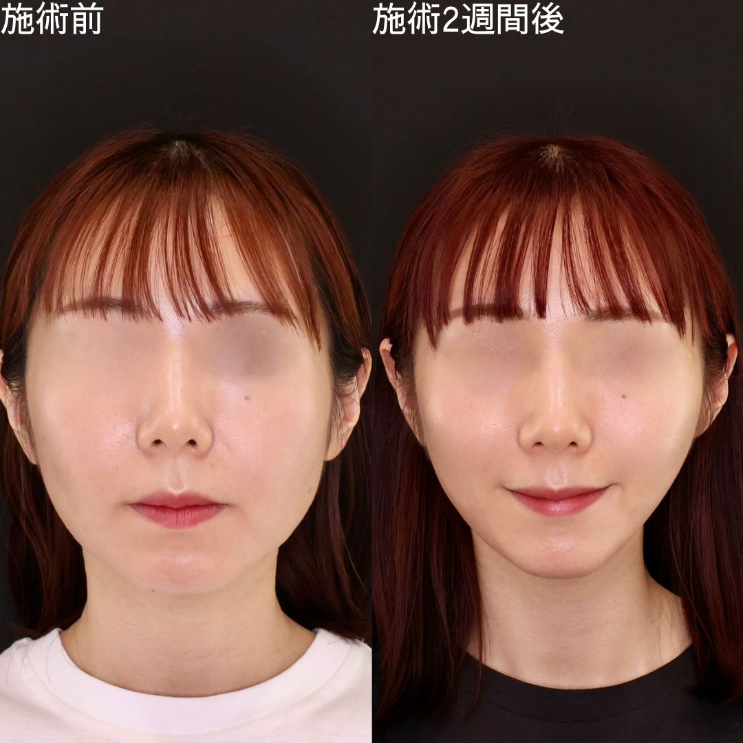 【糸リフト】で顔の余白を減らして垢抜ける！