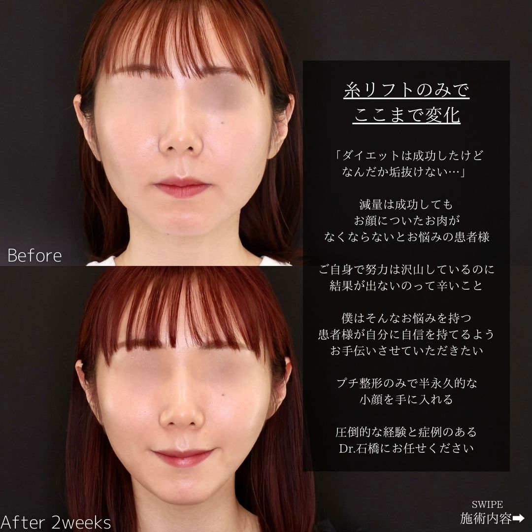 TAC式 ツヤ肌コラーゲンリフト®の症例写真 施術前後 