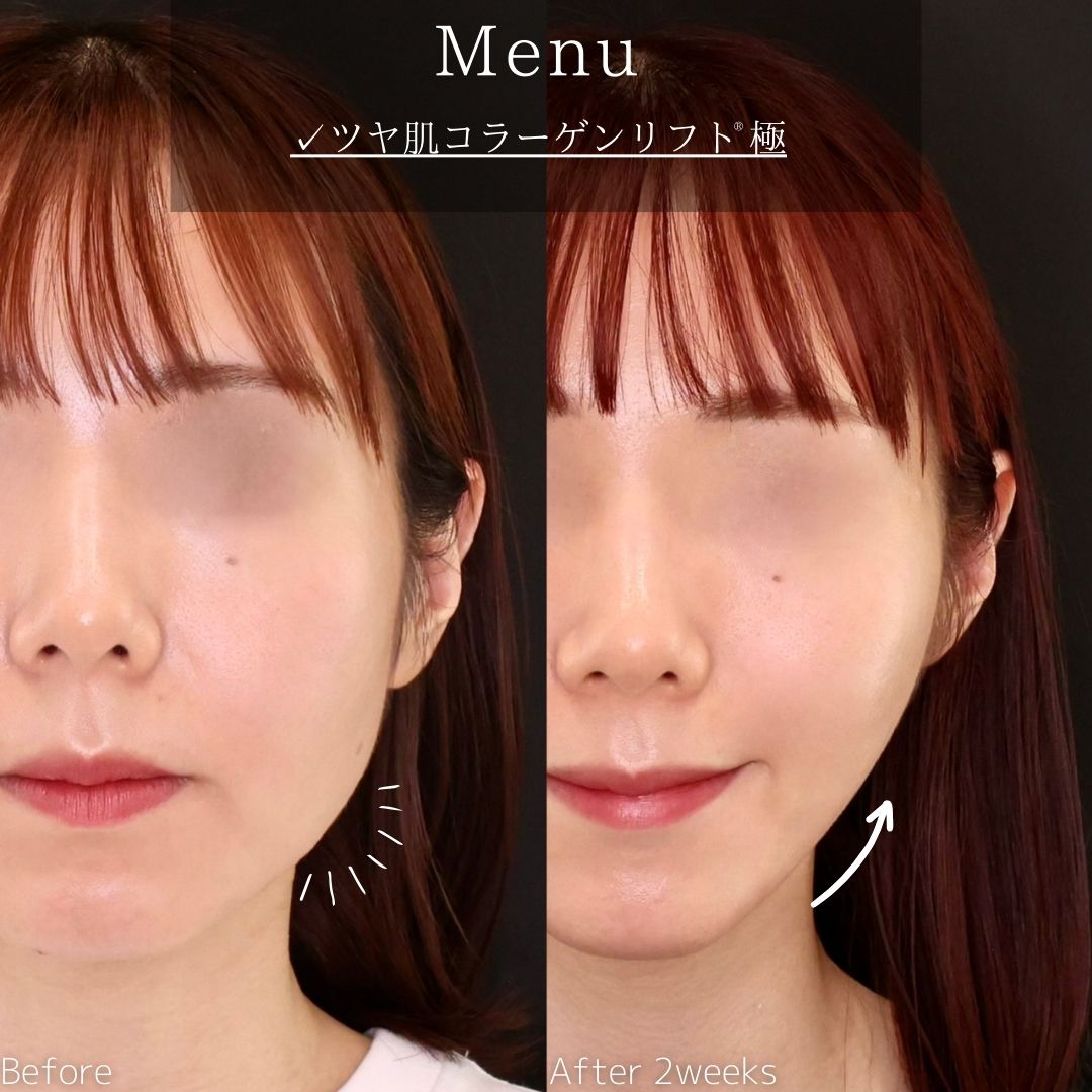 TAC式 ツヤ肌コラーゲンリフト®の症例写真 施術前後 
