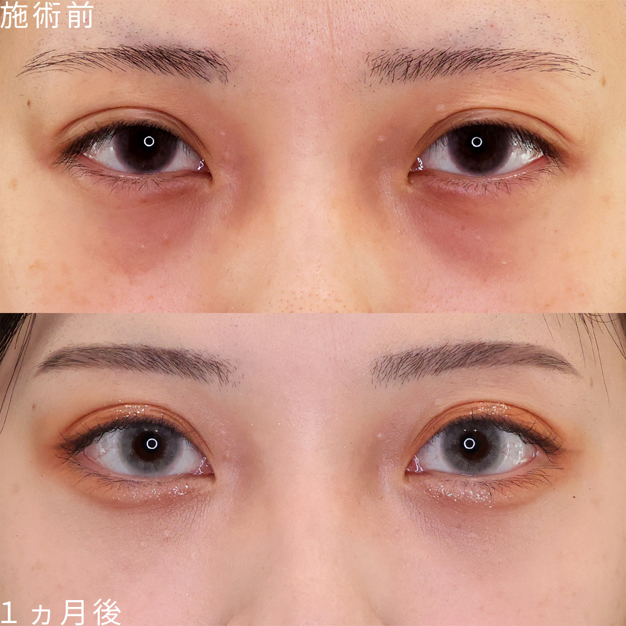 顔の脂肪注入(コンデンスリッチフェイス)の症例写真 施術前後 