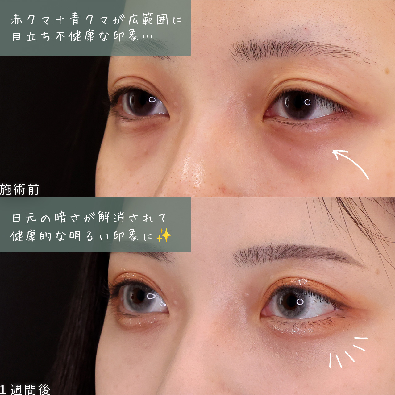 顔の脂肪注入(コンデンスリッチフェイス)の症例写真 施術前後 