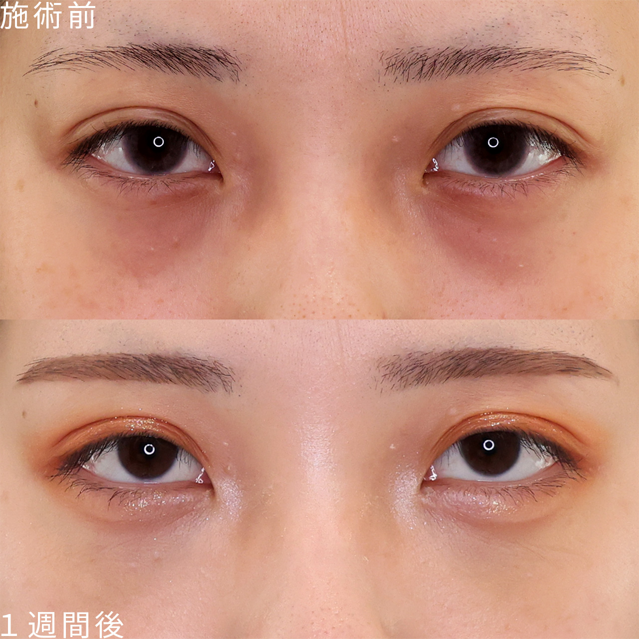 【裏ハムラ＋脂肪注入】で明るく健康的な目元を手に入れる