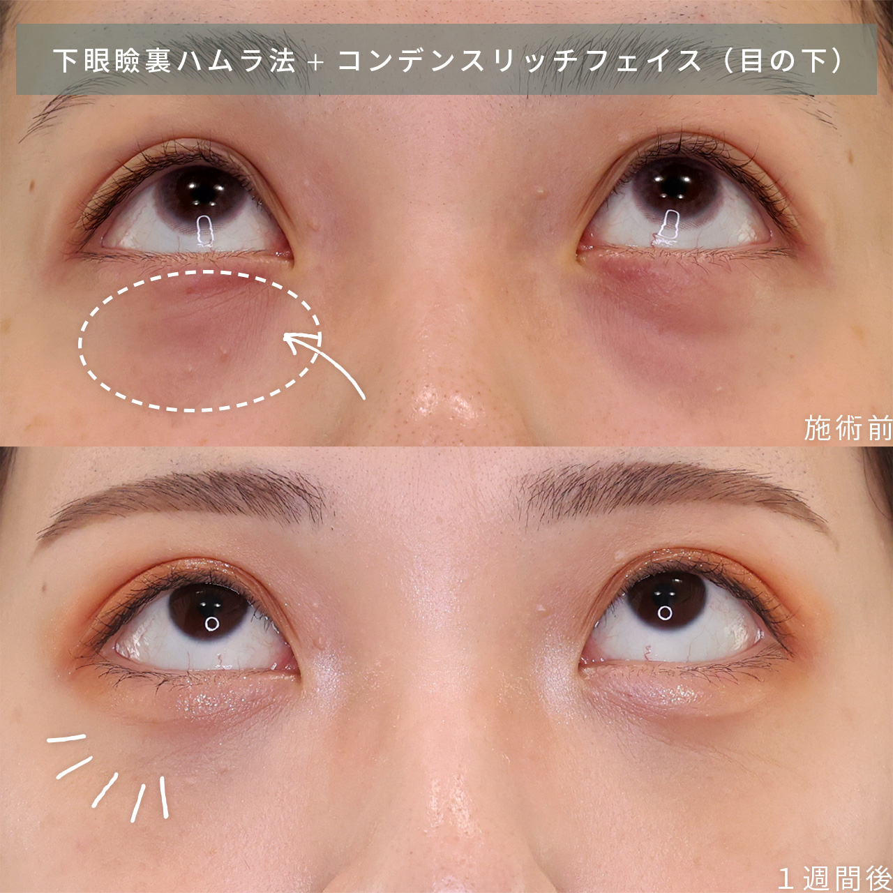 顔の脂肪注入(コンデンスリッチフェイス)の症例写真 施術前後 