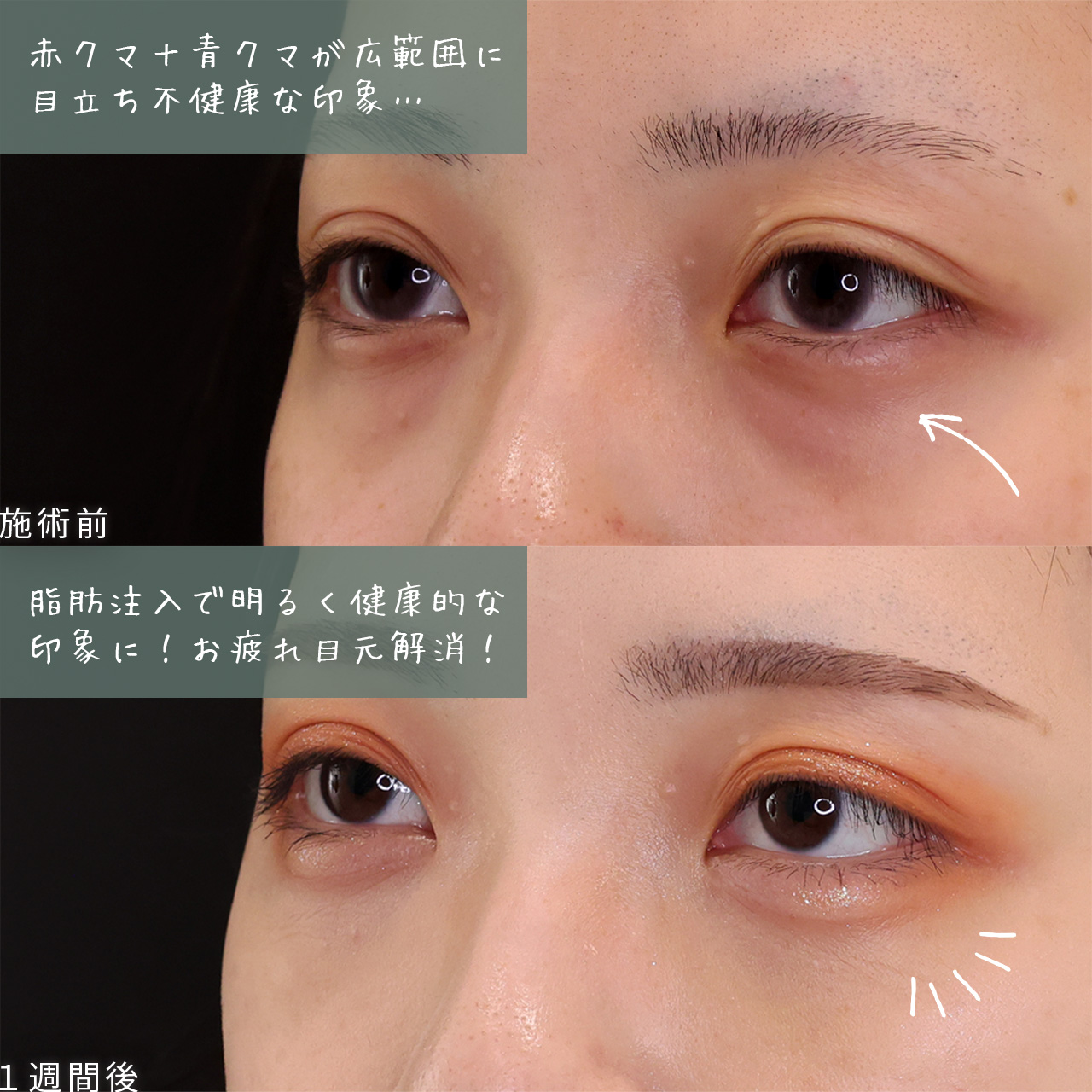 顔の脂肪注入(コンデンスリッチフェイス)の症例写真 施術前後 