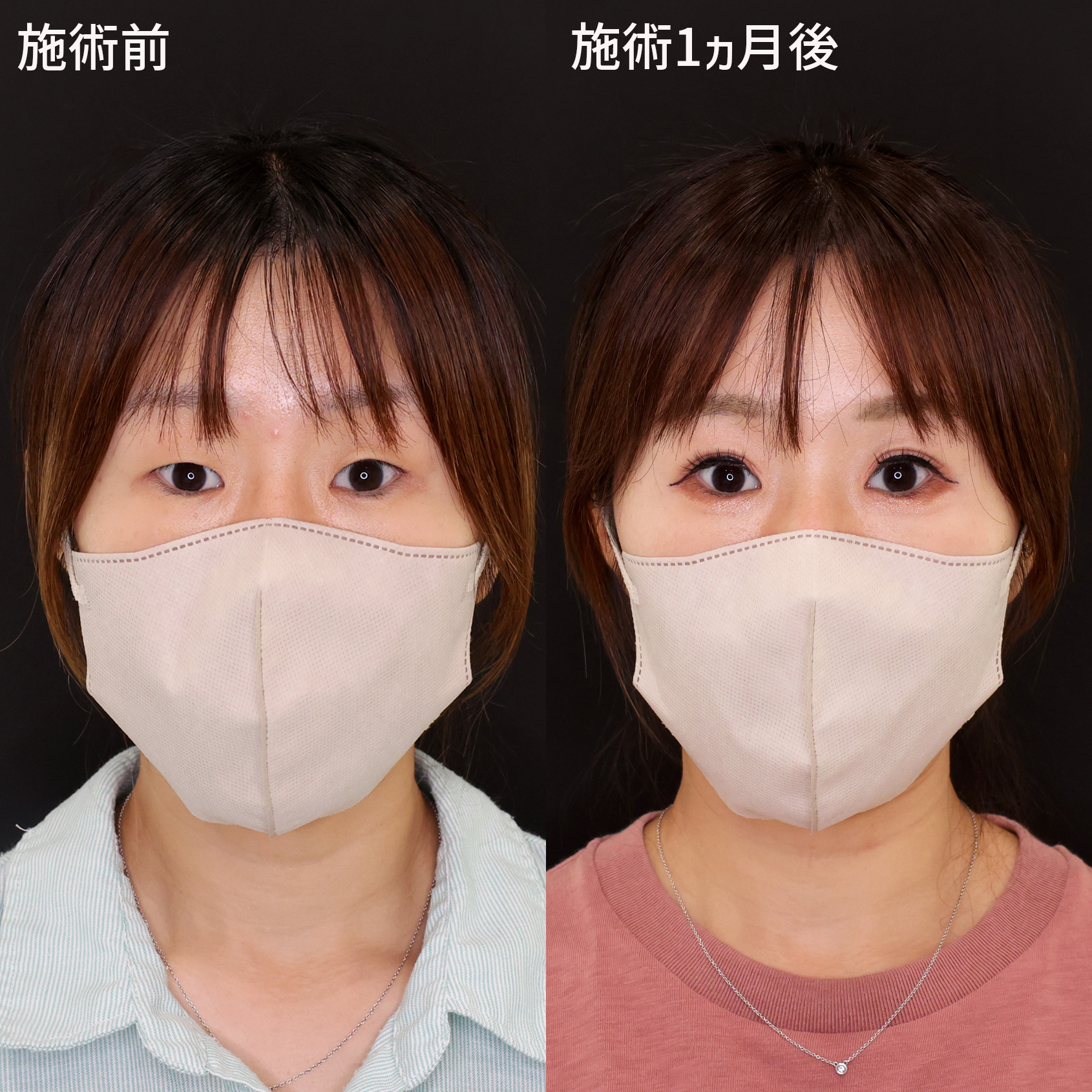 二重埋没法の症例写真 施術前後