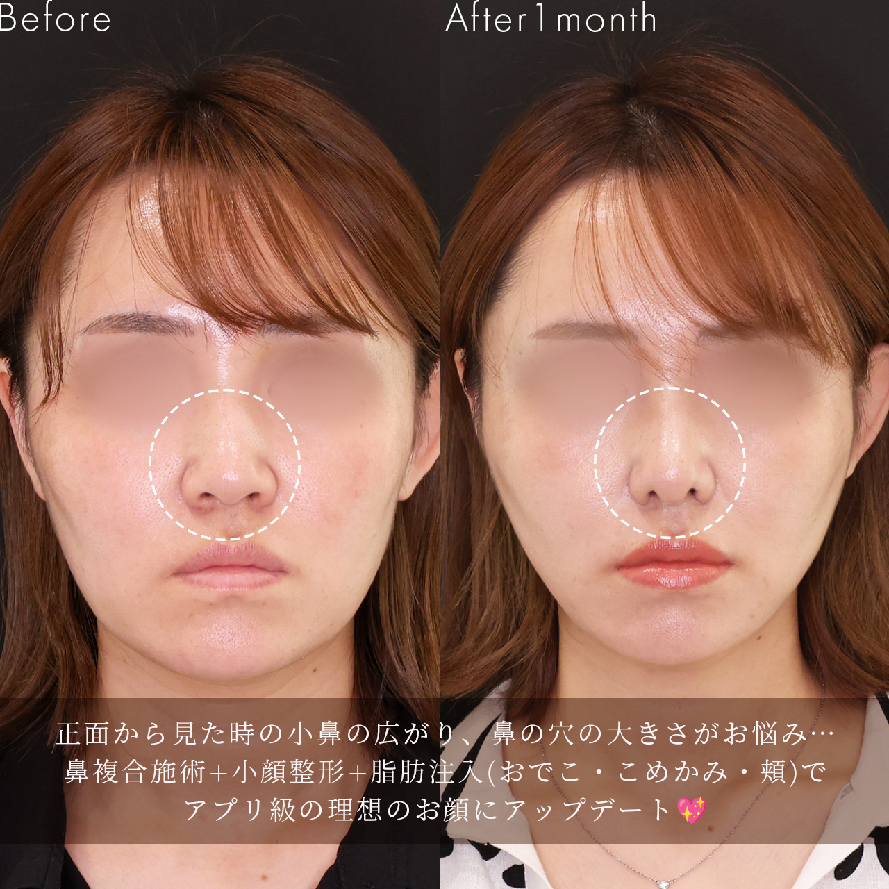 鼻尖形成・鼻尖縮小/TAC式 鼻翼縮小術(小鼻縮小)/TAC式 ツヤ肌コラーゲンリフト®の症例写真 施術前後