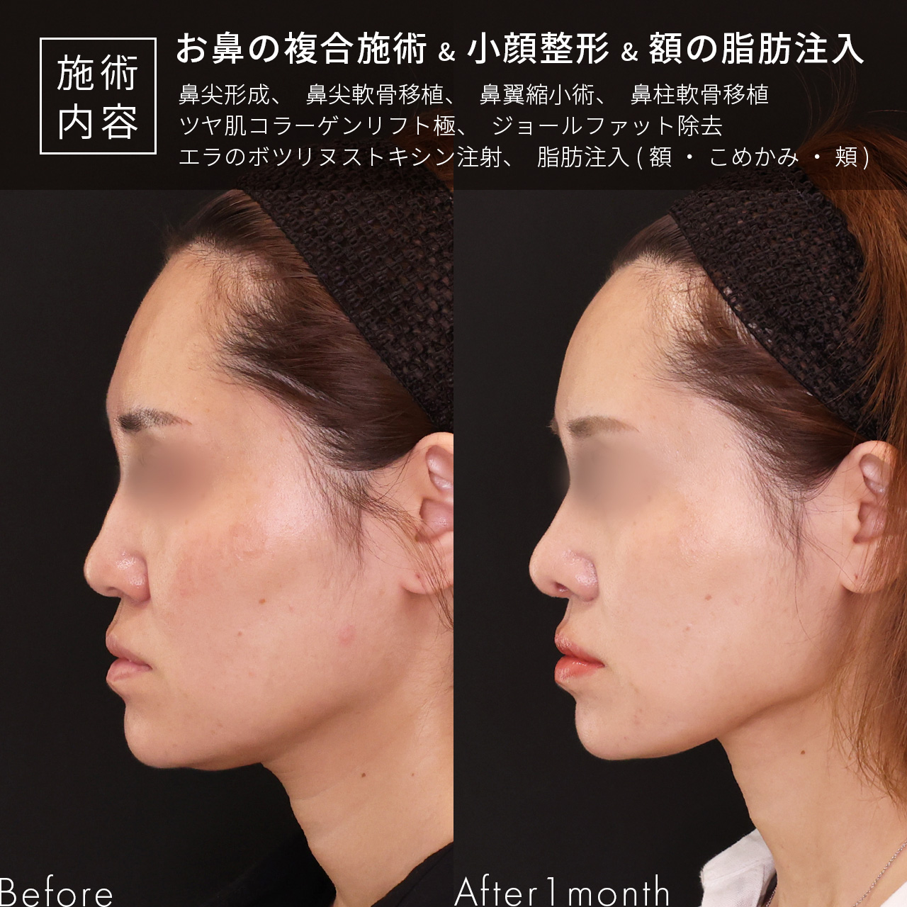 鼻尖形成・鼻尖縮小/TAC式 鼻翼縮小術(小鼻縮小)/TAC式 ツヤ肌コラーゲンリフト®の症例写真 施術前後