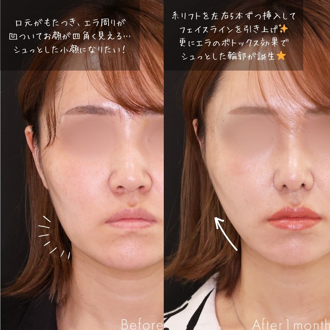 鼻尖形成・鼻尖縮小/TAC式 鼻翼縮小術(小鼻縮小)/TAC式 ツヤ肌コラーゲンリフト®の症例写真 施術前後