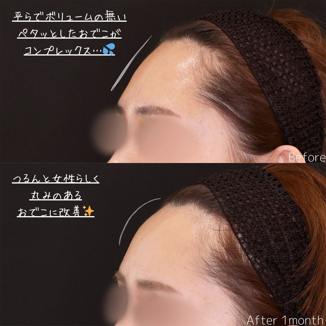 鼻尖形成・鼻尖縮小/TAC式 鼻翼縮小術(小鼻縮小)/TAC式 ツヤ肌コラーゲンリフト®の症例写真 施術前後