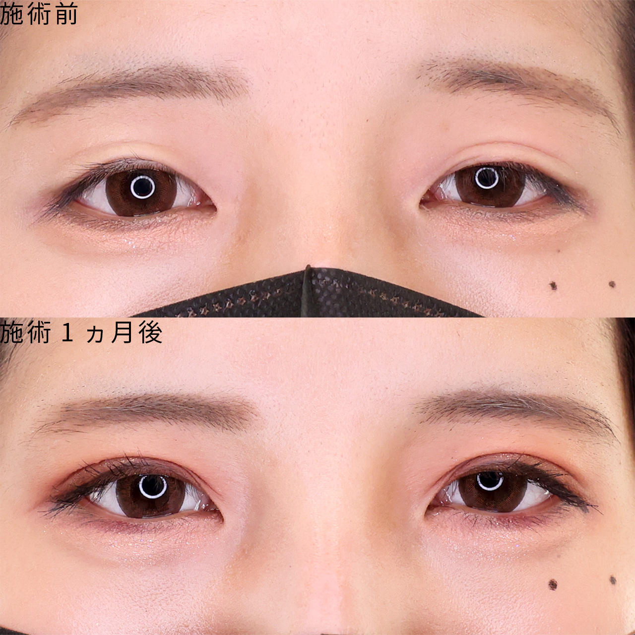 【二重埋没法】左右差を整え理想を叶えるDr.石橋の垢抜け二重術