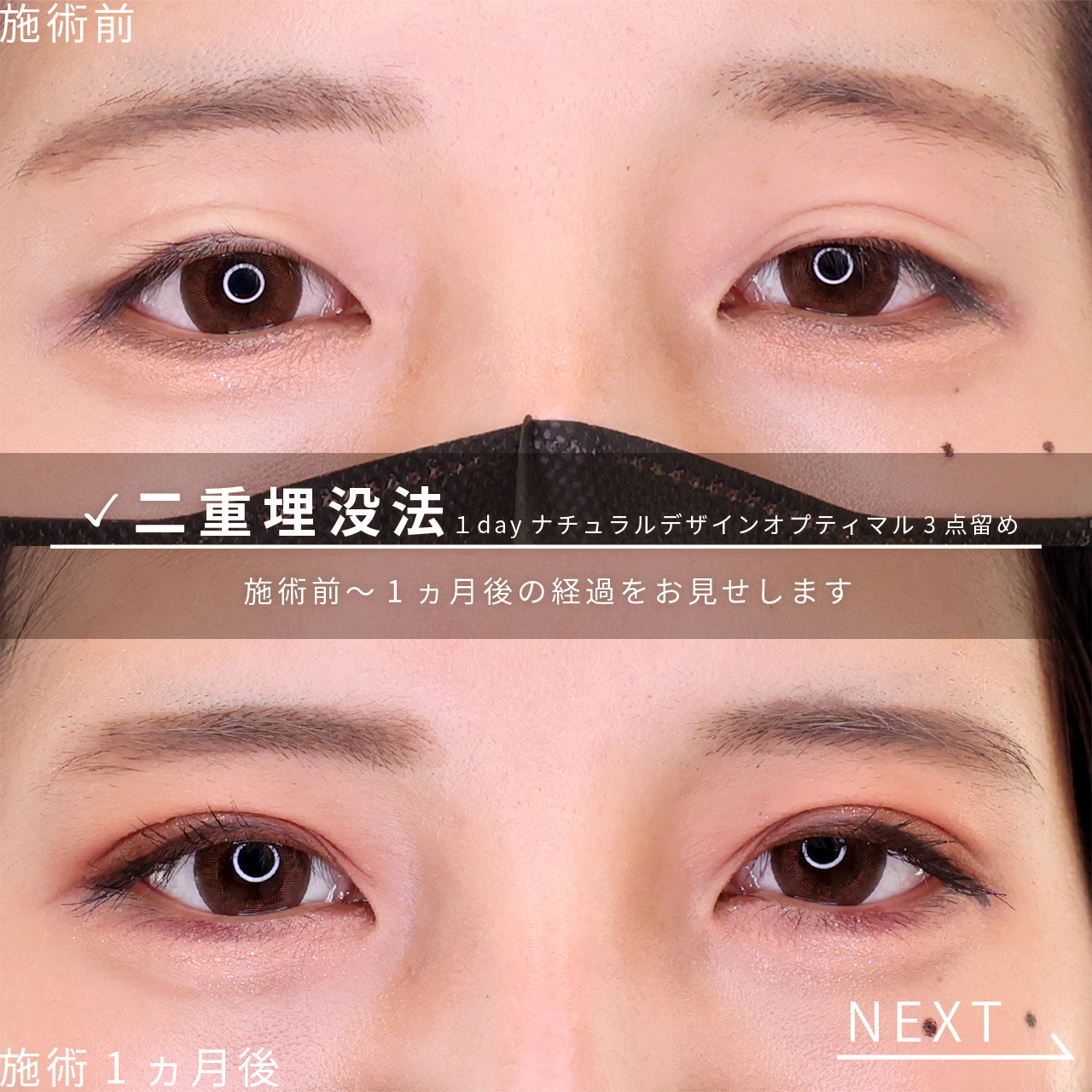 二重埋没法の症例写真 施術前後 