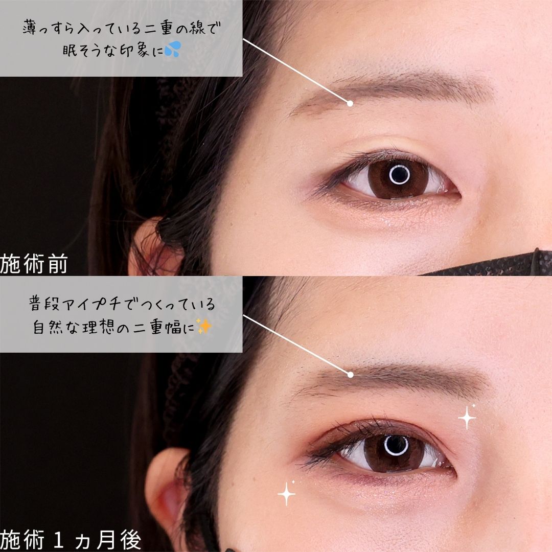 二重埋没法の症例写真 施術前後 