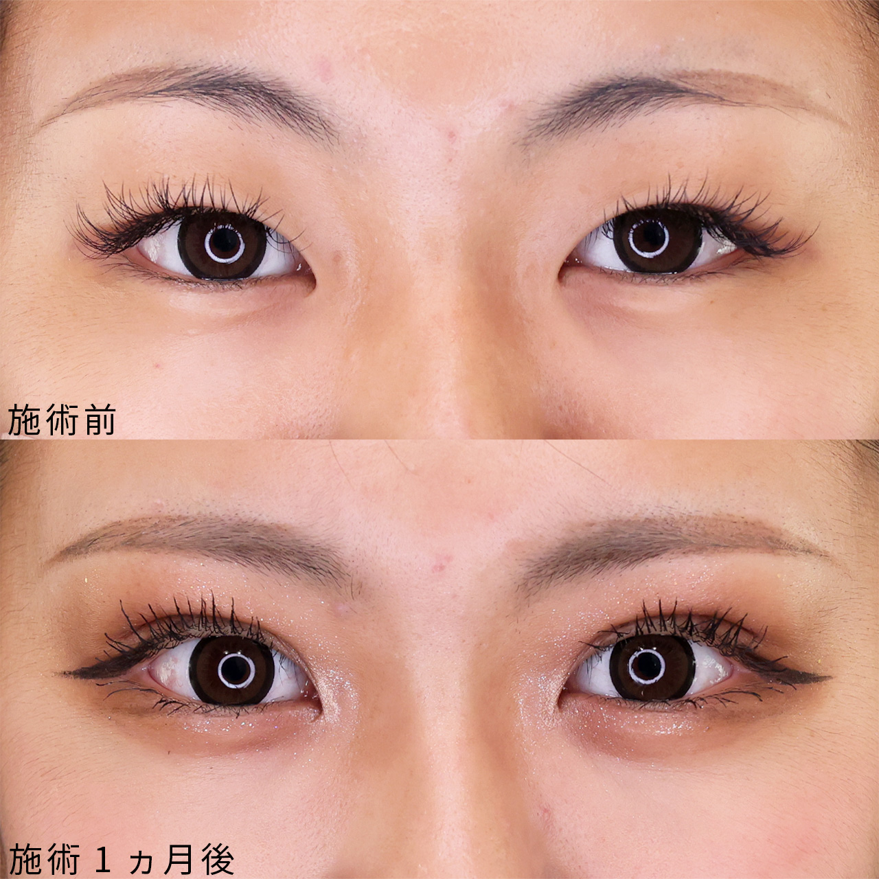 【二重埋没】奥二重を幅広二重にして毎日をHAPPYに♪