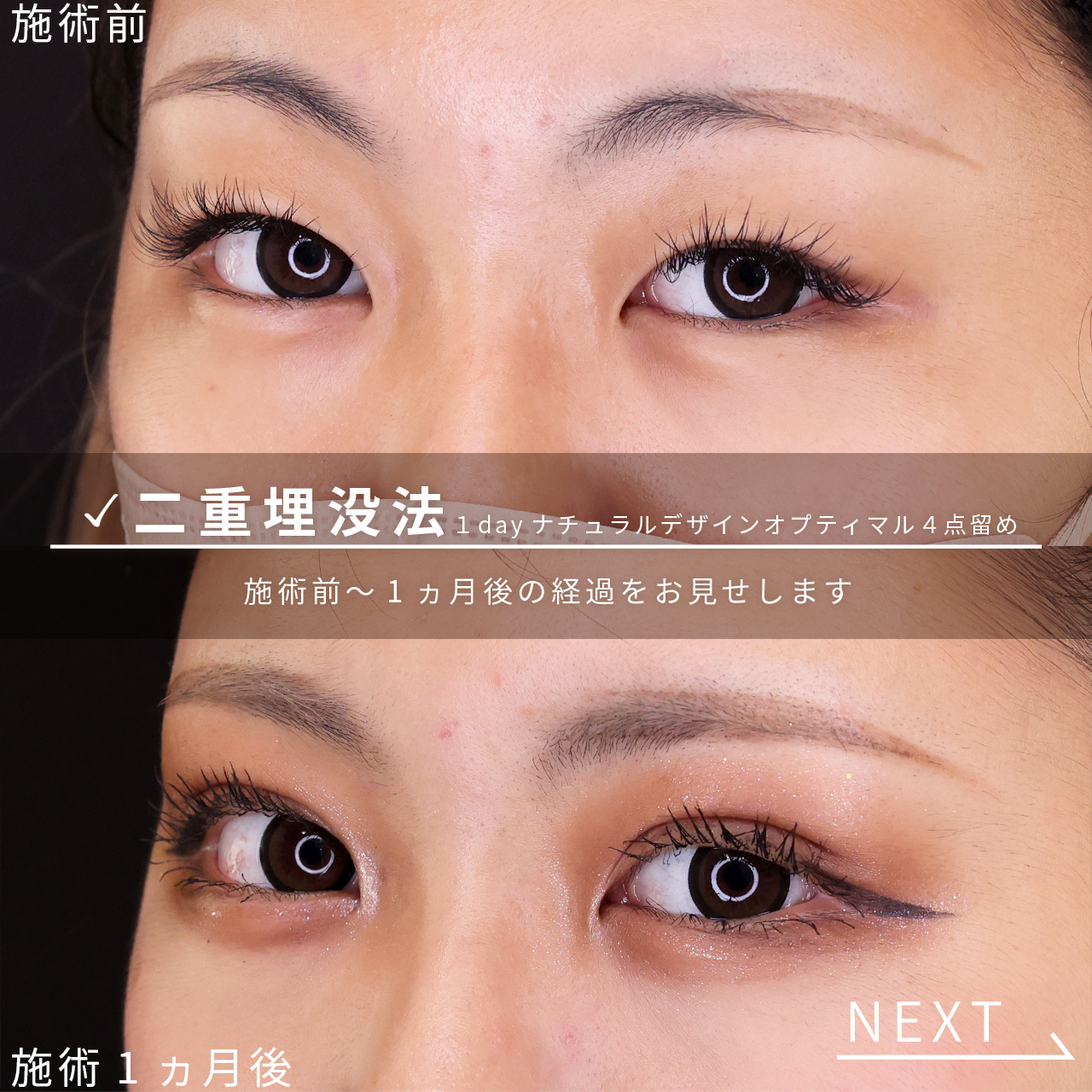 二重埋没法の症例写真 施術前後 