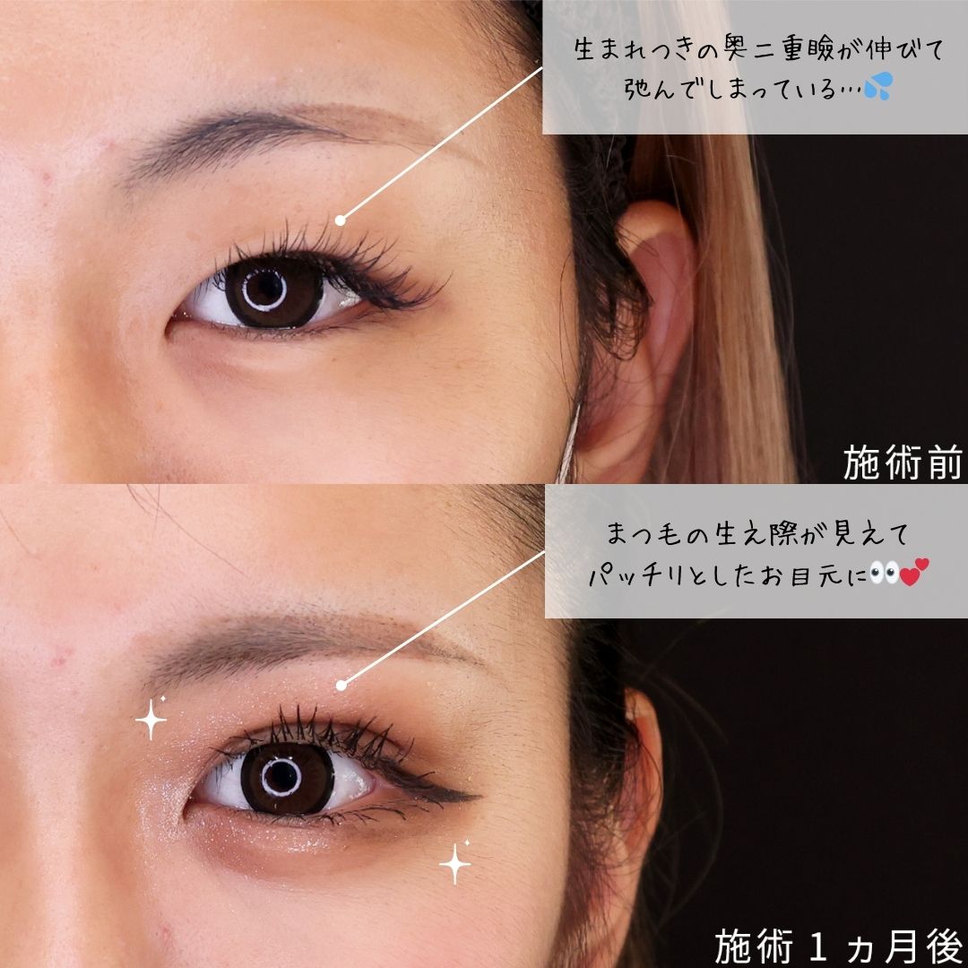 二重埋没法の症例写真 施術前後 